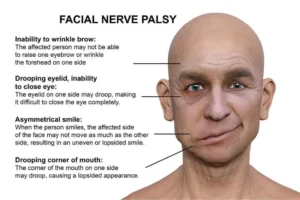bell's palsy