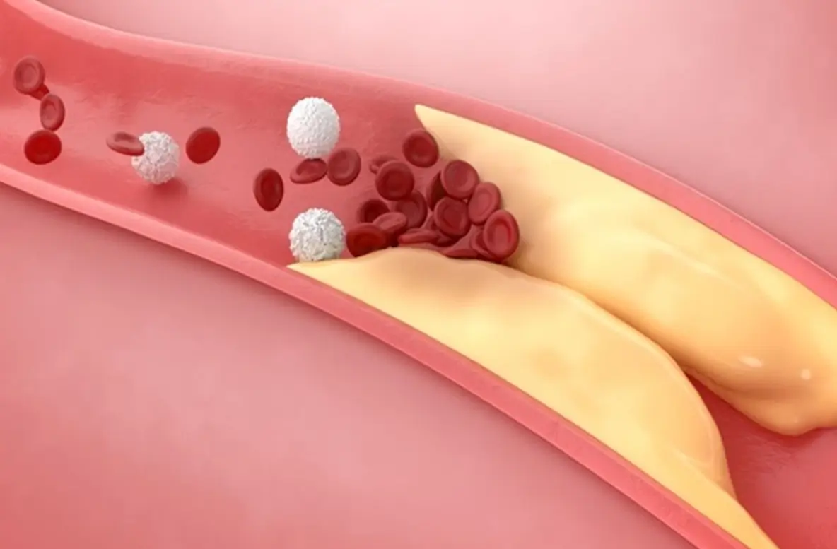 beda asam urat dan kolesterol