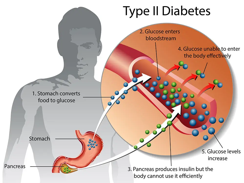 gejala diabetes melitus
